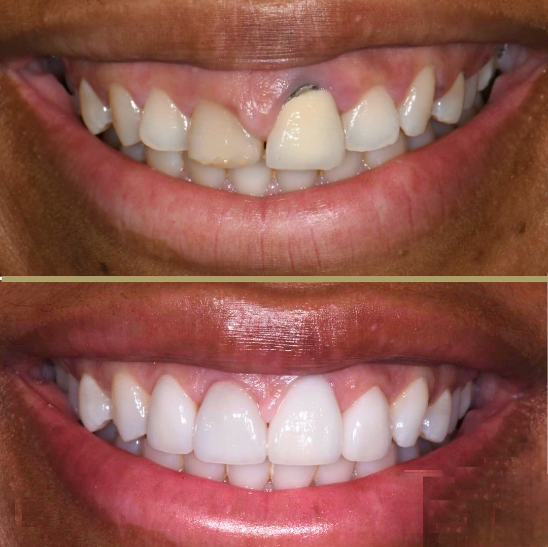 Before and After Dental Transformation