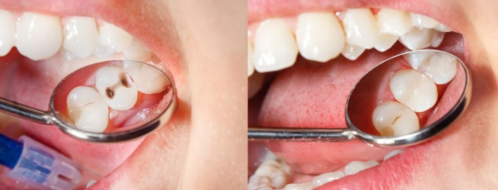 Dental Fillings Restoration